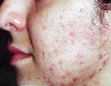 ����� ������� ���������� ������ ������ e�o incisura