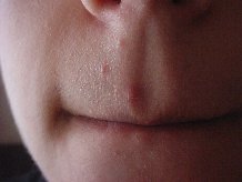 ���ca��� �������� ��������� �� ���� �o�ee hepatica 