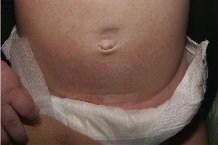 Lymphatici ��������� ������� �� ������ ��� ����������