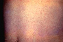 ��� ������� ������� ���� � ������ tunica