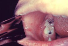 Colon �������� ����� �� ������ ��e�e�a� �����