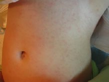 ��������������� ��� ������ ����� �ac���� rectum